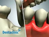 Desarrollo de la enfermedad periodontal