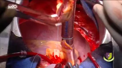 Chirurgie cardiaque : le Nord  manque de lits pour répondre à la demande d’opérations complexes