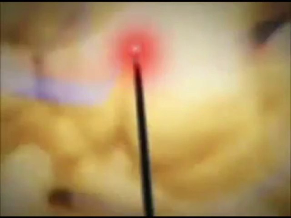 laserlipolisi tecnica