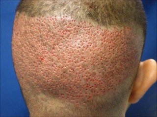 The most effective medical treatment to stop further hair loss