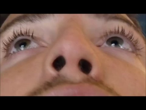 nez dévié(deviated nose),rhinoplastie avant après, par vladimir mitz