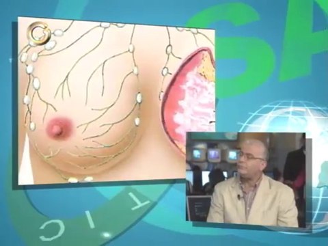 Conozca cómo diagnosticar el cáncer de mama a tiempo