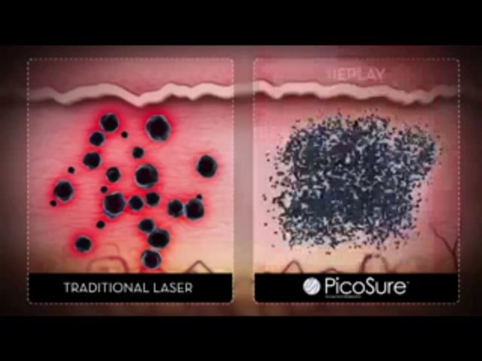 PicoSure Tattoo