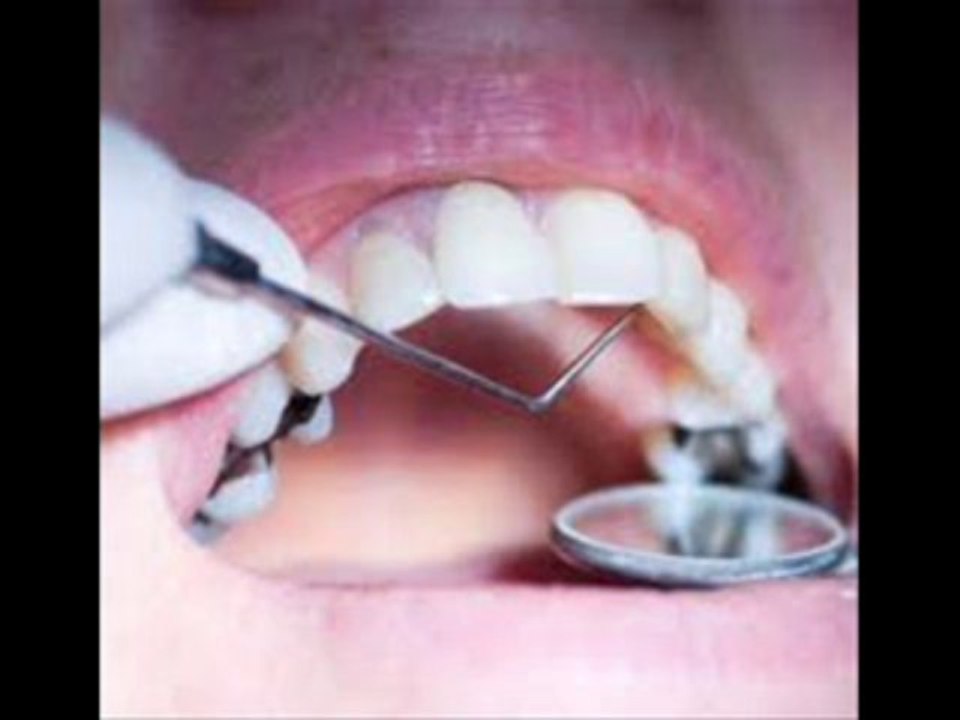 Dr.Robert Tupac DDS Dental amalgam