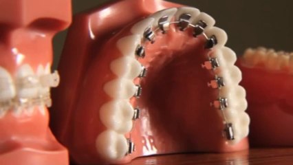 Braces Are Far More Attractive Than Crooked Teeth