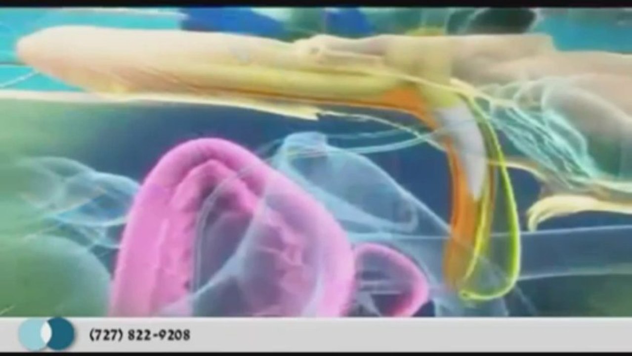 Treating Erectile Dysfunction with Penile Implants in Tampa