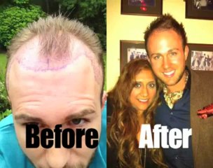 Hair Transplant Manchester | CALL 0161 871 0815
