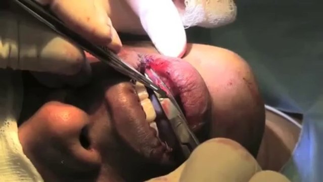 Lip Reduction - New York - Dr. Philip Miller