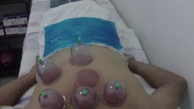 DİYARBAKIR SÜLÜK HACAMAT TEDAVİSİ 0535 411 59 14