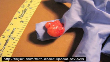 truth about lipoma review