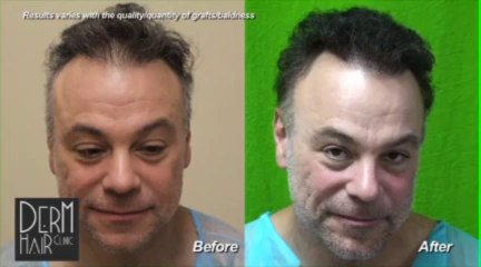 Beard to Head Hair Transplant