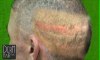 Depleted Donor for Hair Transplant by FUE