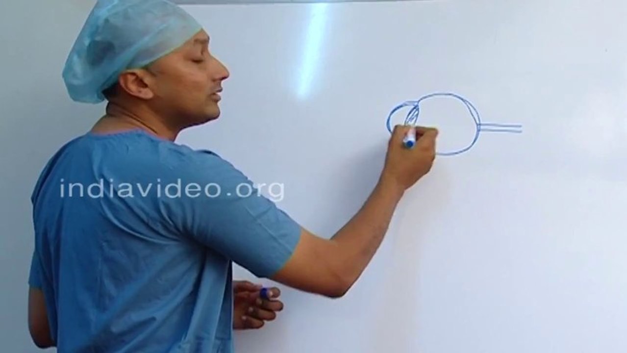 What is Cataract ?