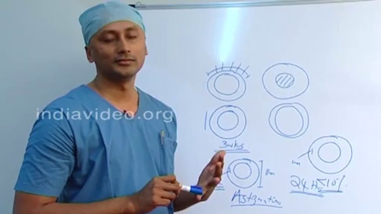 Types of Cataract Surgery