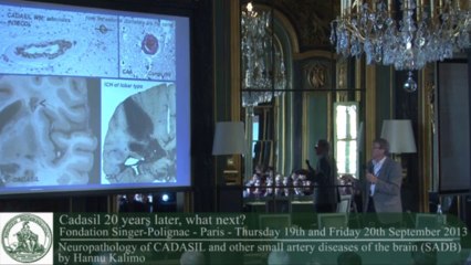 Hannu Kalimo - Neuropathology of CADASIL and other small artery diseases of the brain (SADB)
