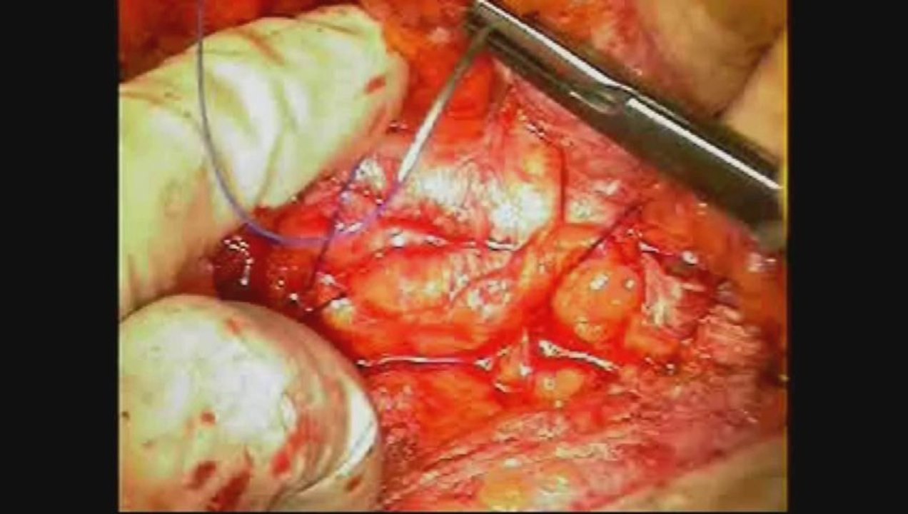 Open Abdominal Wall Reconstruction What Have We Learned
