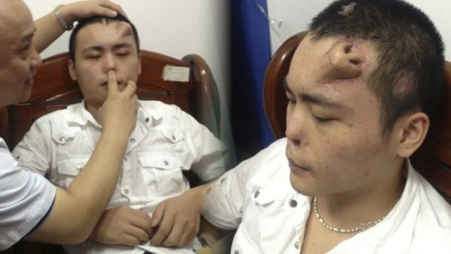 Doctors Grow Replacement Nose on Man's Forehead
