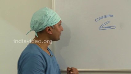 What is blade free LASIK Surgery