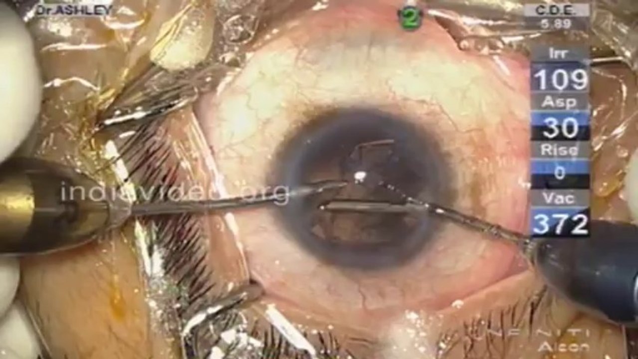 Micro Cataract Surgery  Mulamoottil Eye Hospital Kozhencherry Kerala