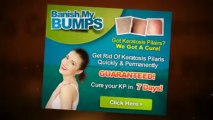Banish My Bumps Free | Banish My Bumps Download