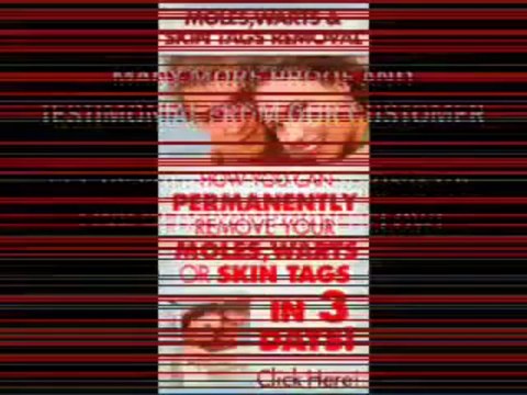 Moles Warts And Skin Tags Removal - How To Safely,Permanently Remove Moles, Warts,Skin Tags