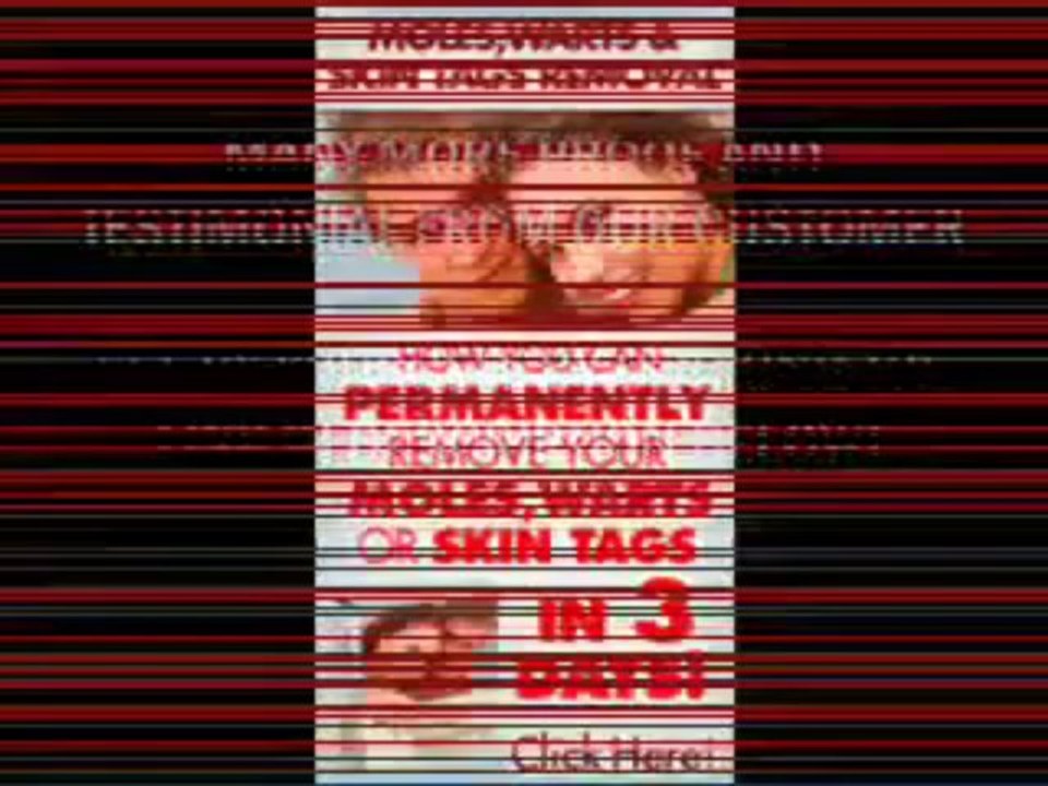 Moles Warts And Skin Tags Removal - How To Safely,Permanently Remove Moles, Warts,Skin Tags