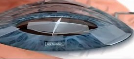 The LensX Laser Procedure (Cataract Surgery)