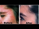 Eczema Free Forever Review | Shocking Truth Of Eczema Free Forever Revealed!!