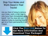Does Moles Warts Removal Work   Moles Warts & Skin Tags Removal