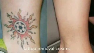 easy way get rid tattoo - Tattoo Removal Cream
