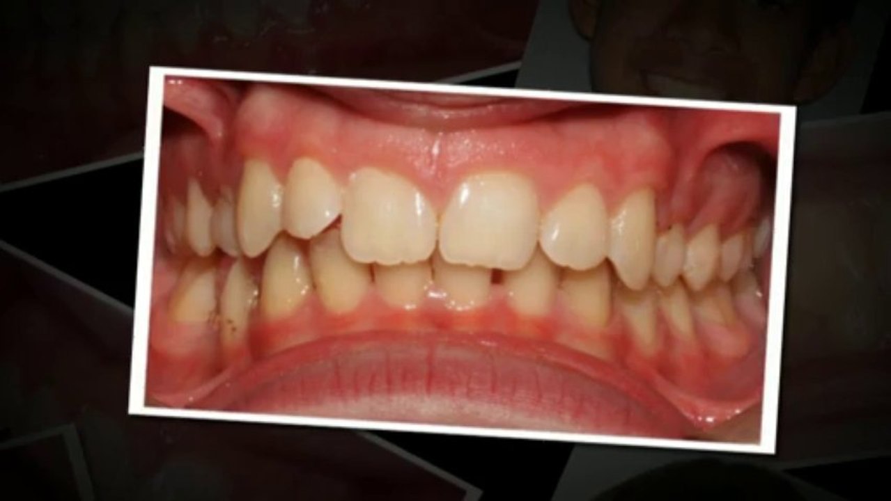 Invisalign Dallas Sept2013