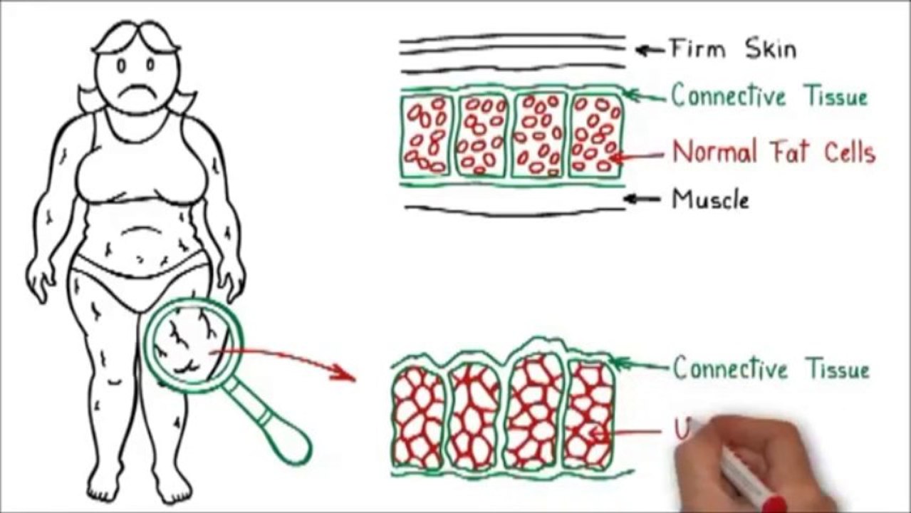 Cellulite Factor Program | Fat Loss Factor | Reviews