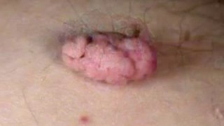 Skin Tags Removal and Treatment