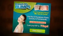 Banish My Bumps Free Download | Banish My Bumps Free