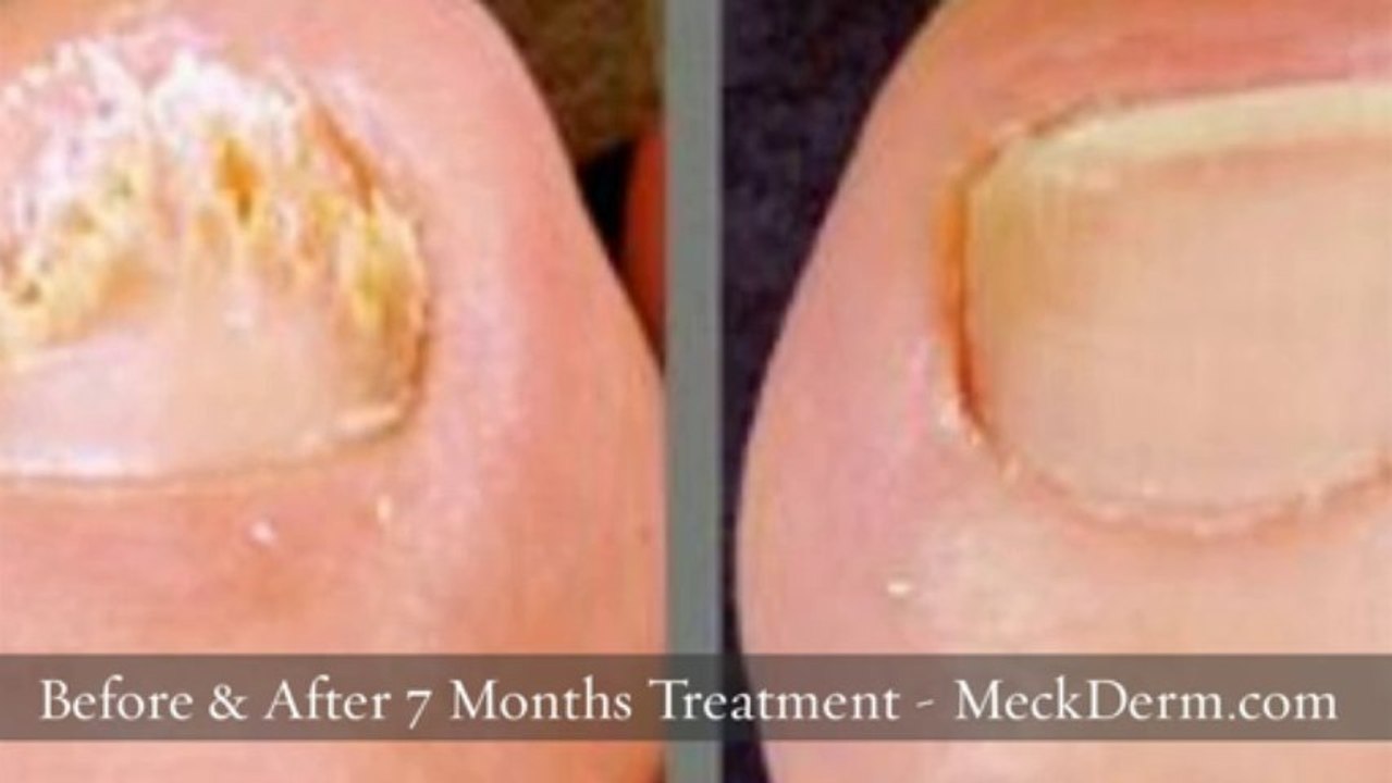 Nail Fungus Treatment Charlotte NC 704-344-8846