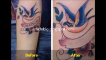 Laser Tattoo Removal - Get Rid Tattoo [Discounted Price]