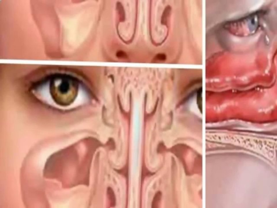 how to cure nasal polyps naturally - nasal polyps treatment
