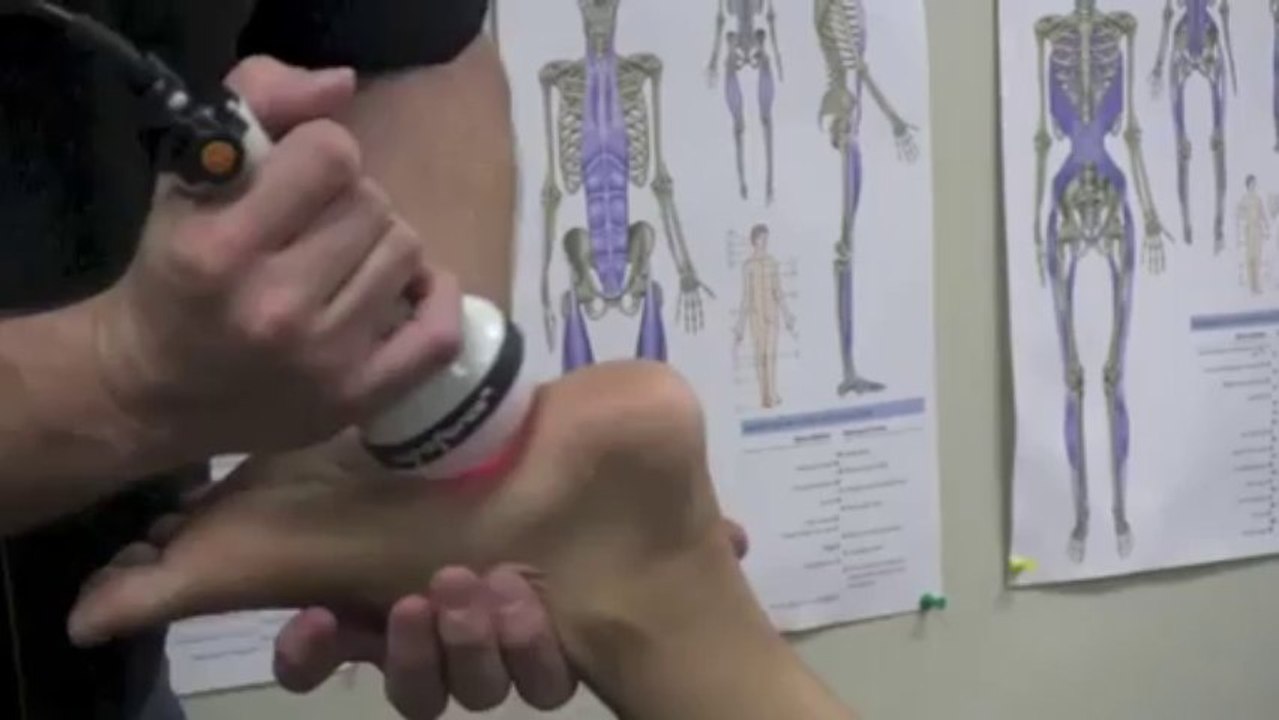 Treating Plantar Fasciitis with Deep Tissue Laer Therapy