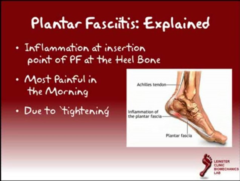 Plantar Fasciitis Explained