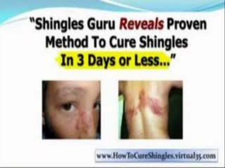Fast Shingles Cure Review +  Fast Shingles Cure