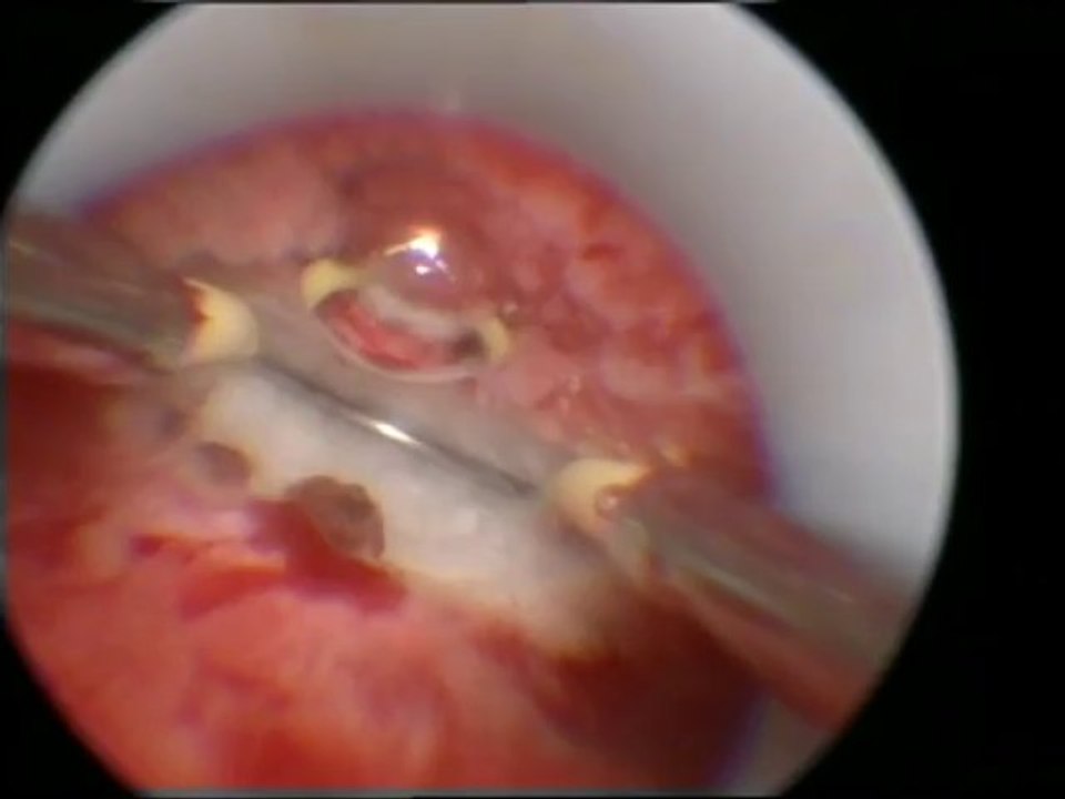 Uterus Subseptum (Rahimde yarım perde) kesilmesi