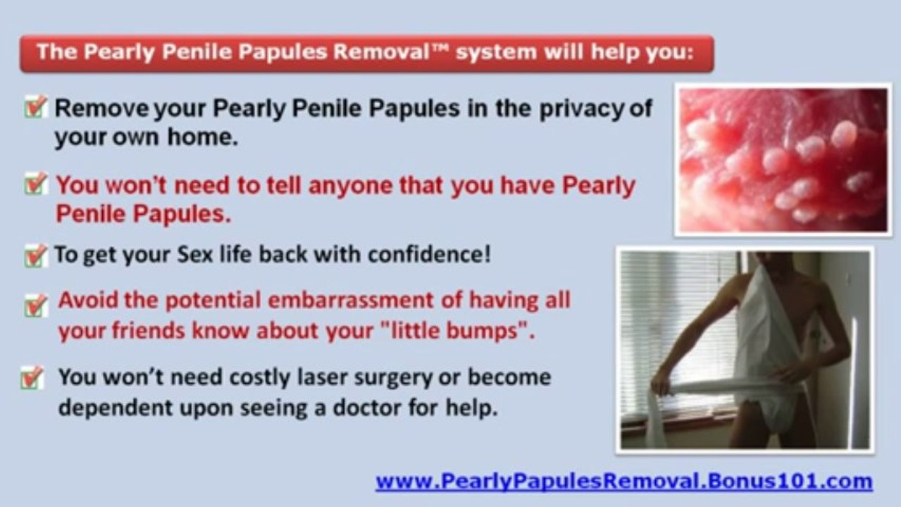 In penis papules Pearly penile