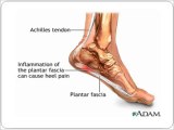 Pain in Heel of Foot | How to Get Rid of Plantar Fasciitis, Achilles Tendonitis Pain in Heel of Foot
