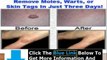Moles Warts And Skin Tags Removal + Moles Warts And Skin Tag Removal