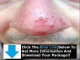 How To Get Rid Of Herpes Permanently   How To Get Rid Of Herpes Bumps