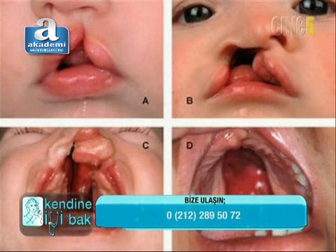 Kendine iyi bak - Doğuştan gelen dudak ve damak yarıkları