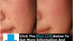 Moles Warts & Skin Tags Removal + Charles Davidson Moles Warts Removal