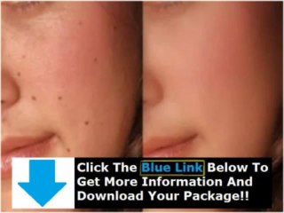 Moles Warts & Skin Tags Removal + Charles Davidson Moles Warts Removal