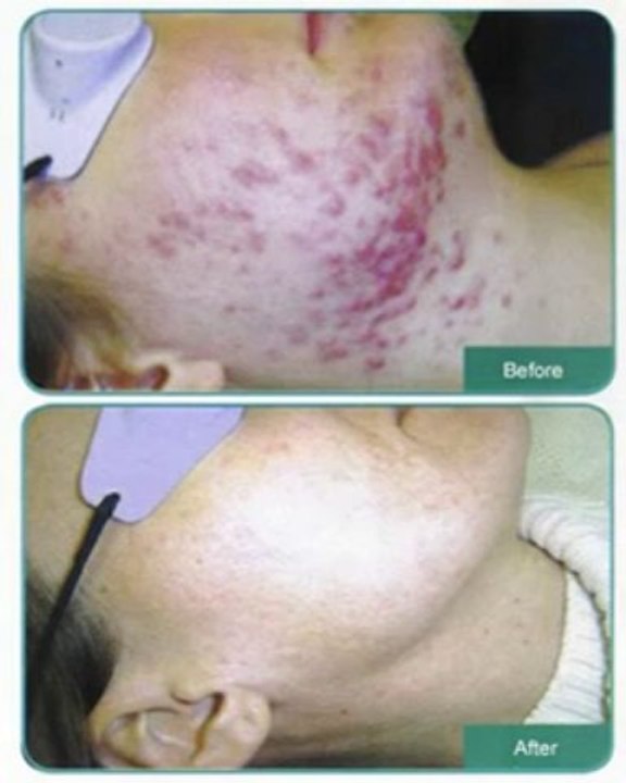 acne no more Review + Bonus