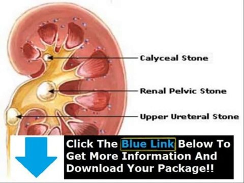 Remedy Of Kidney Stone + Coke For Kidney Stone Remedy